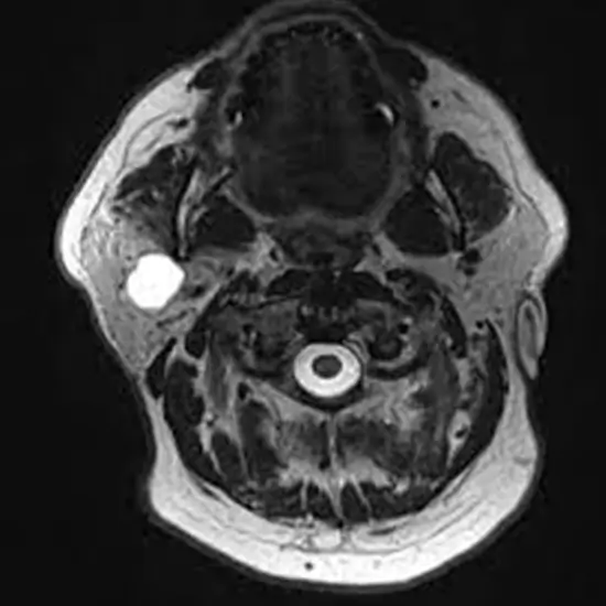 MRI Screening Of Parotid
